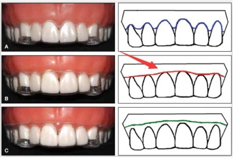 Can the clear aligner trimming style be customized
